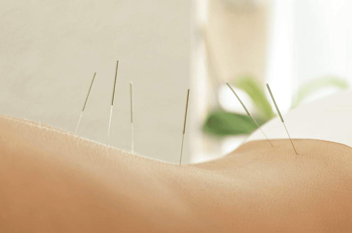 Acupuncture